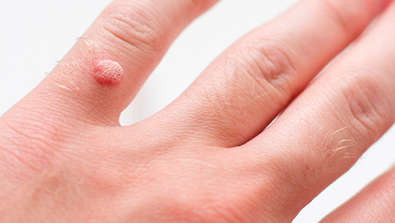 Indolent Nodes/Warts